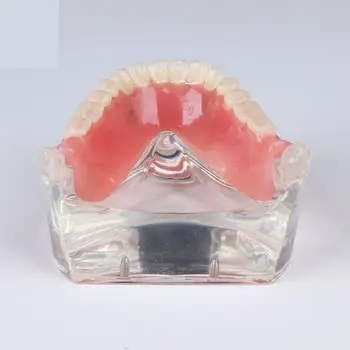 Стоматологическая модель для изучения зубов Overdenture Inferior 4 Демонстрационная модель имплантата  10